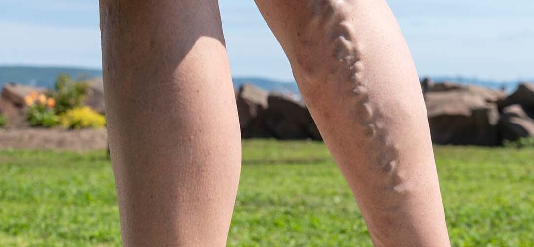 female leg with varicose veins